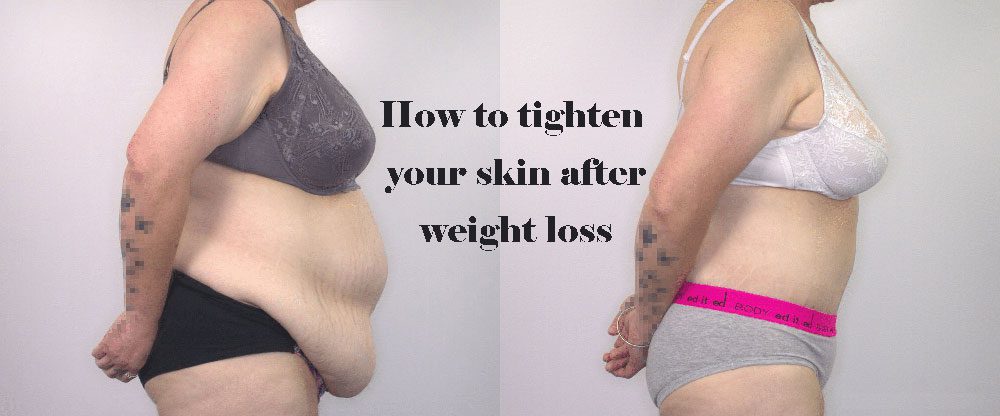 How to tighten skin after weight loss naturally