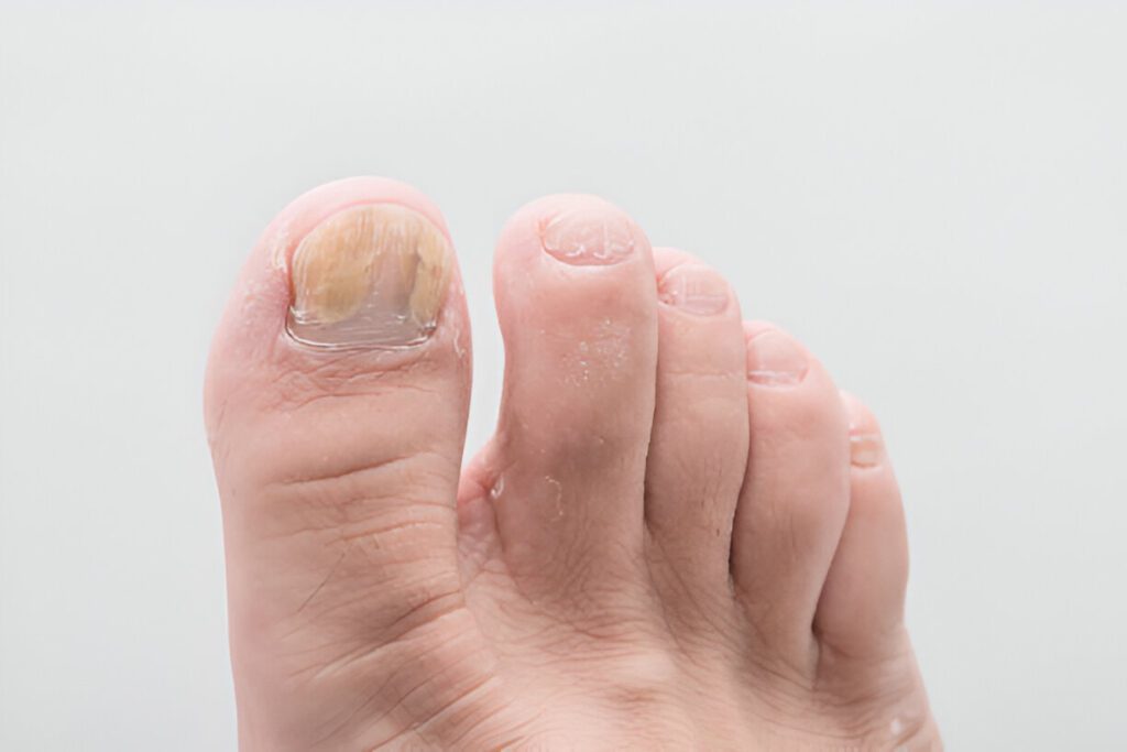 How to Know If Toenail Fungus Is Dying