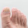 How to Know If Toenail Fungus Is Dying